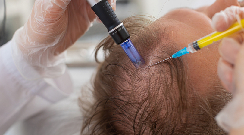 Stammzellentherapie-freie Exosomenbehandlung gegen Haarausfall