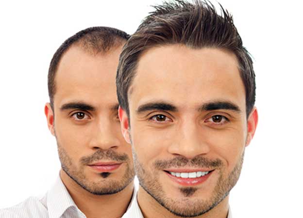 Who is suitable for hair transplantation?