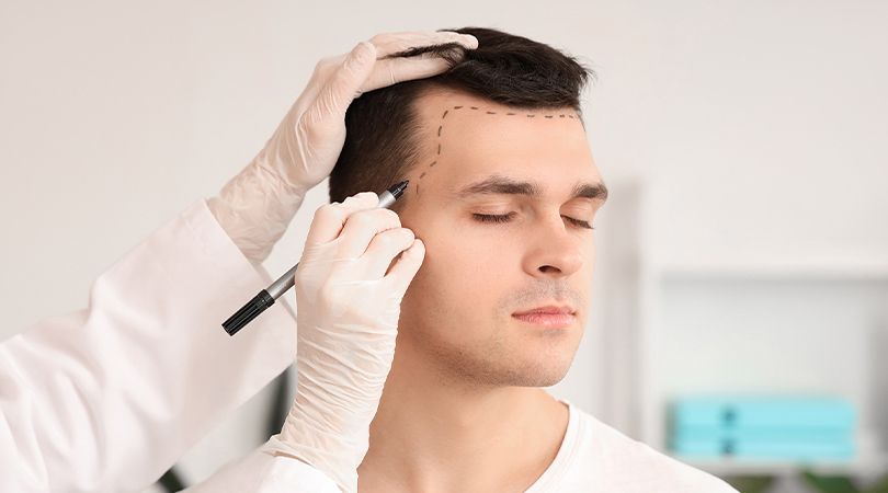 Processus Après la Greffe de Cheveux