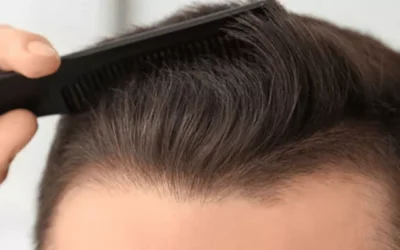 Hair Transplant Without Shaving