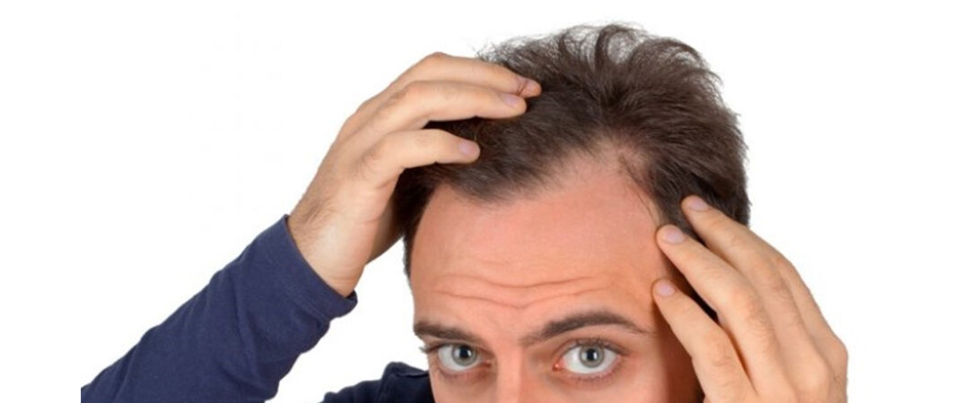 Definitive solution for baldness
