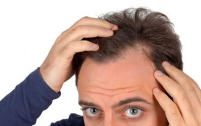 Definitive solution for baldness