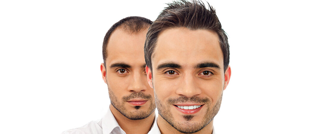 Current Hair Transplant Applications